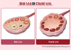[국가건강정보포털 건강정보] 4월 '다낭성 난소 증후군 관리법'